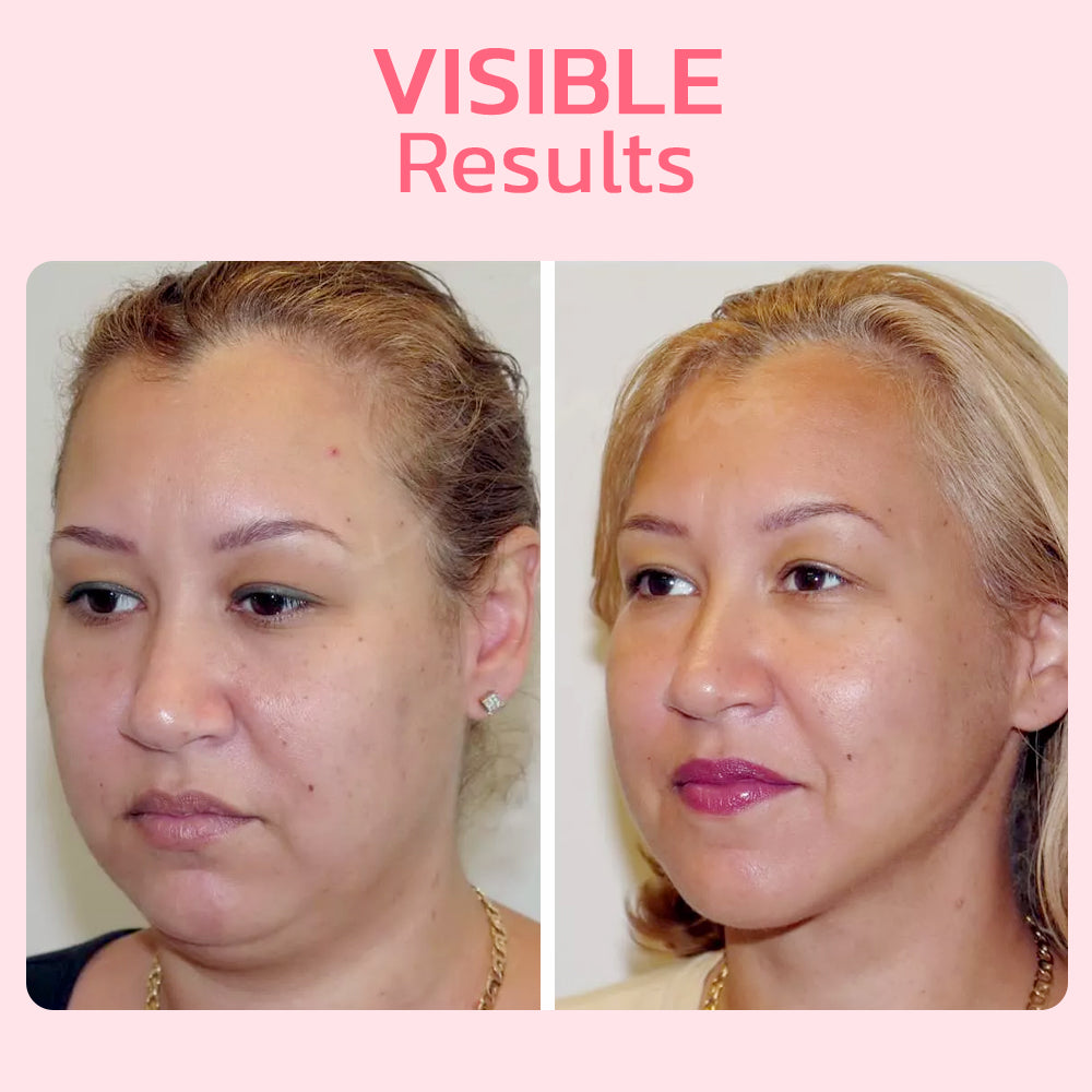 flysmus™ V Gesichtsabsaugung Beauty Trainer